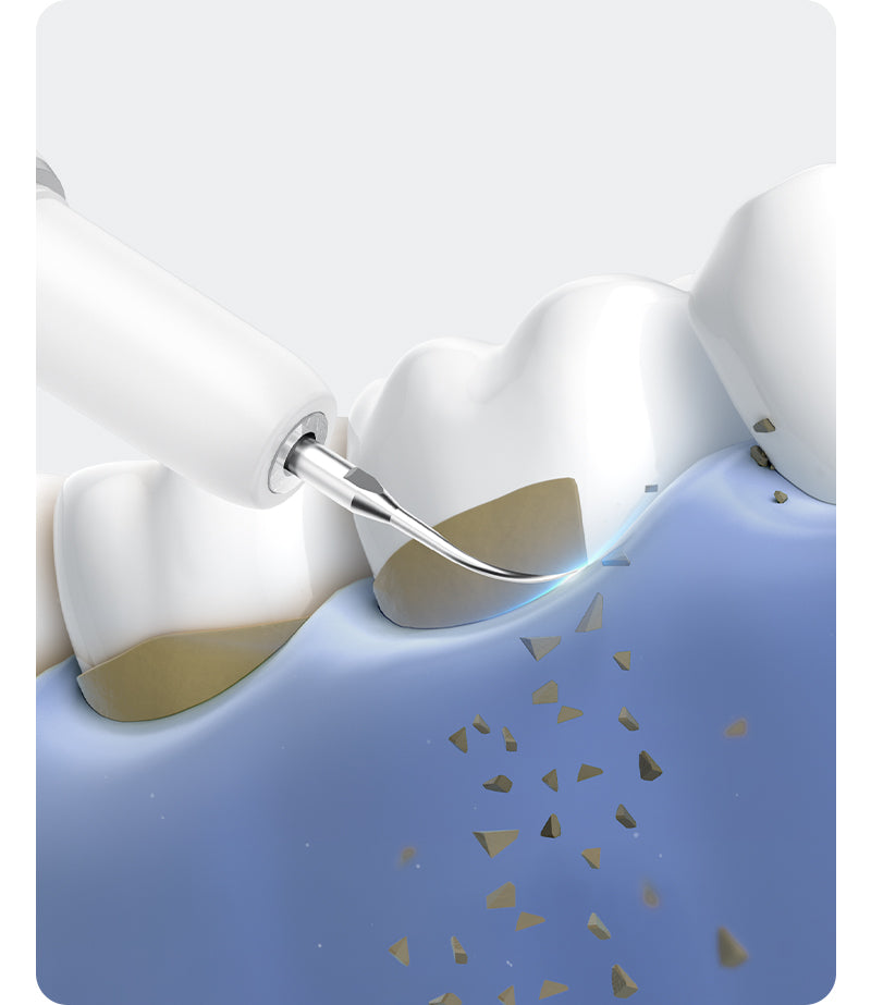 Medical illustration of professional teeth cleaning using a dental scaler to remove tartar around the tooth root.