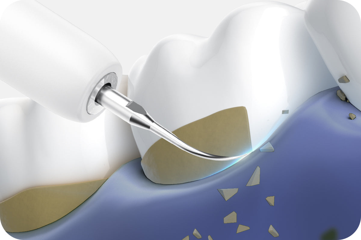 Medical illustration of professional teeth cleaning using a dental scaler to remove tartar around the tooth root.