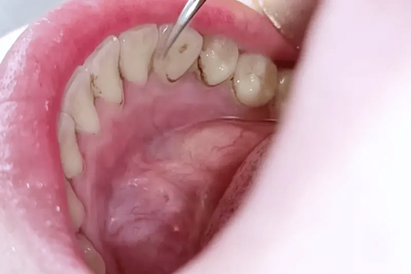 “This Is How I Finally Stopped Tartar from  Rebuilding—Even After an $800 Deep  Clean!”