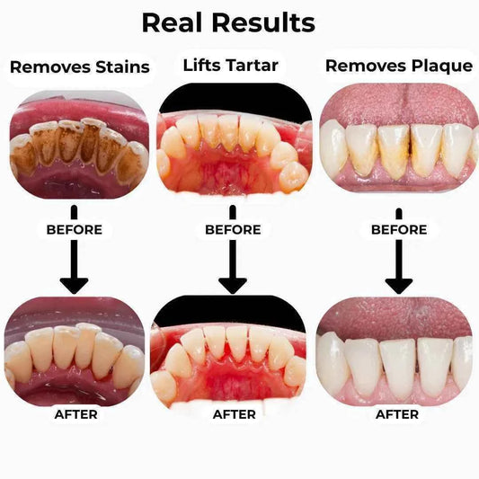 T11 Ultrasonic Teeth Cleaner for Plaque & Tartar Removal